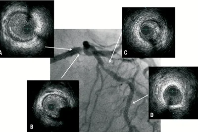 IVUS, Colling & RFA